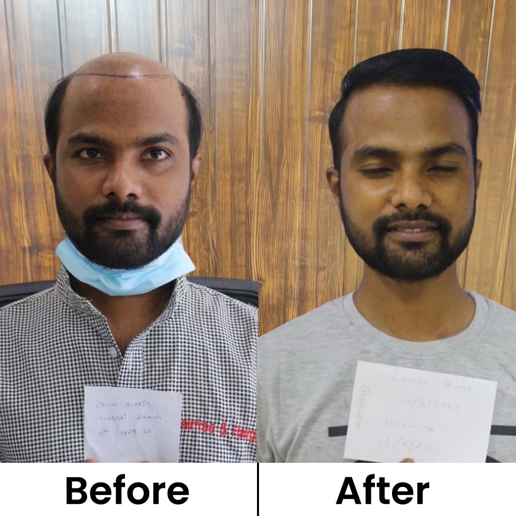 Before After