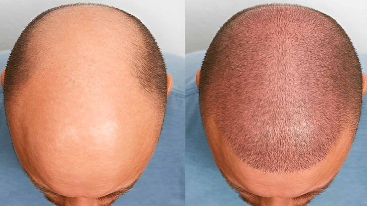 Pre & Post Hair Transplant Care