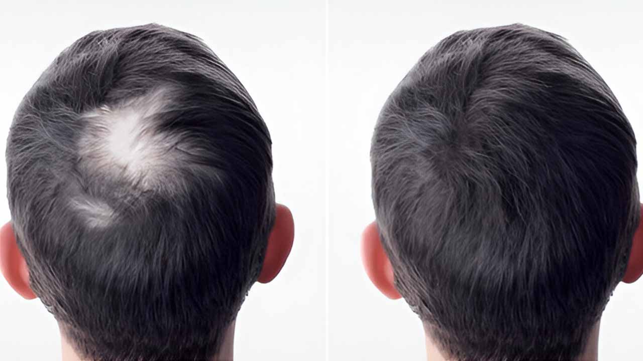 Crown Area Hair Transplant