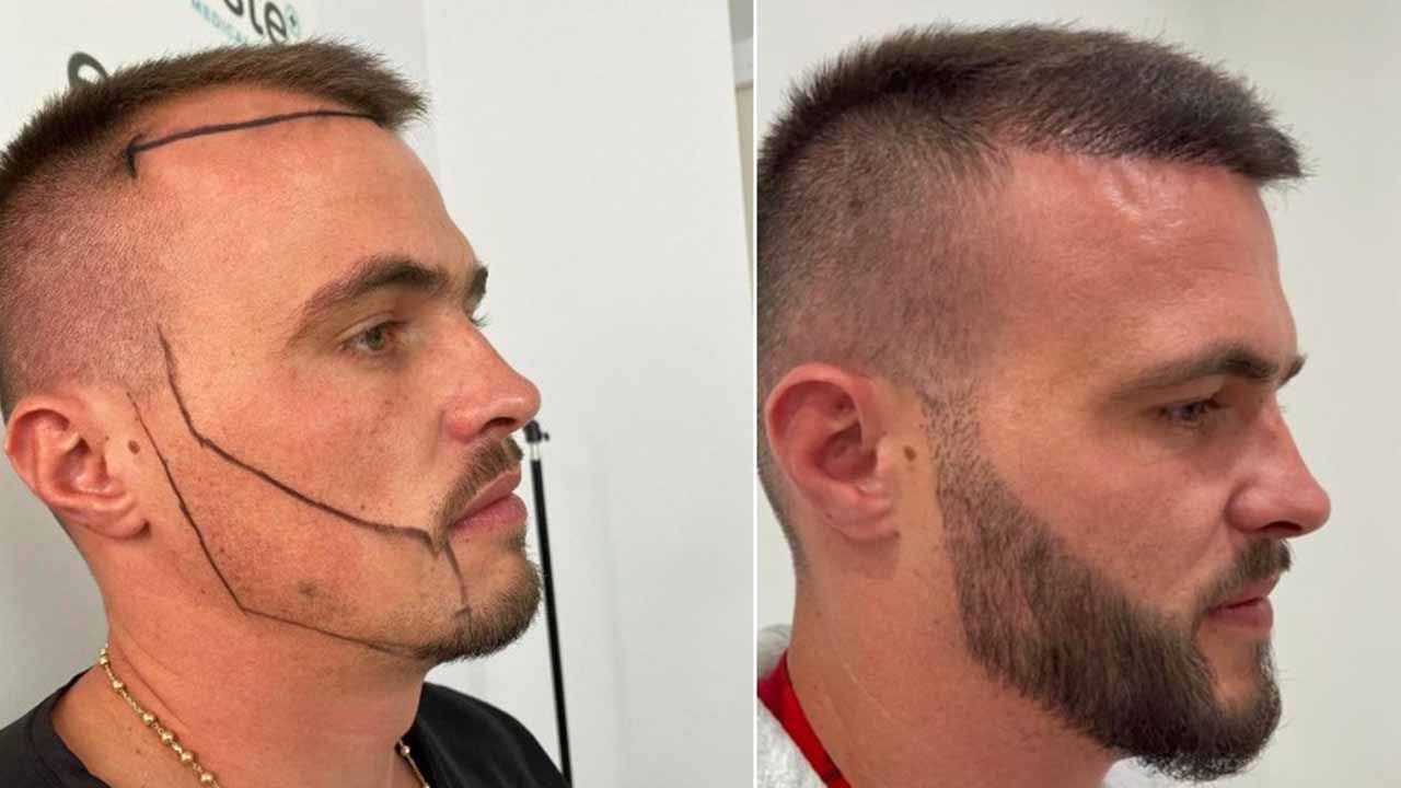 Beard Hair Transplant