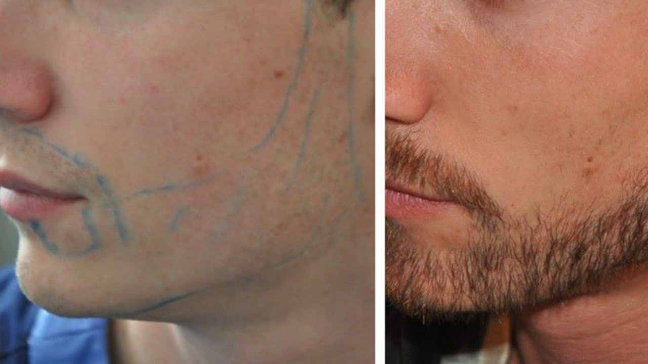 Moustache Hair Transplant