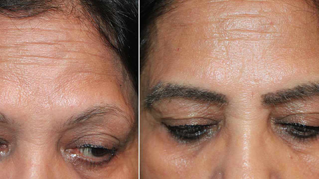 Eyebrow Transplant