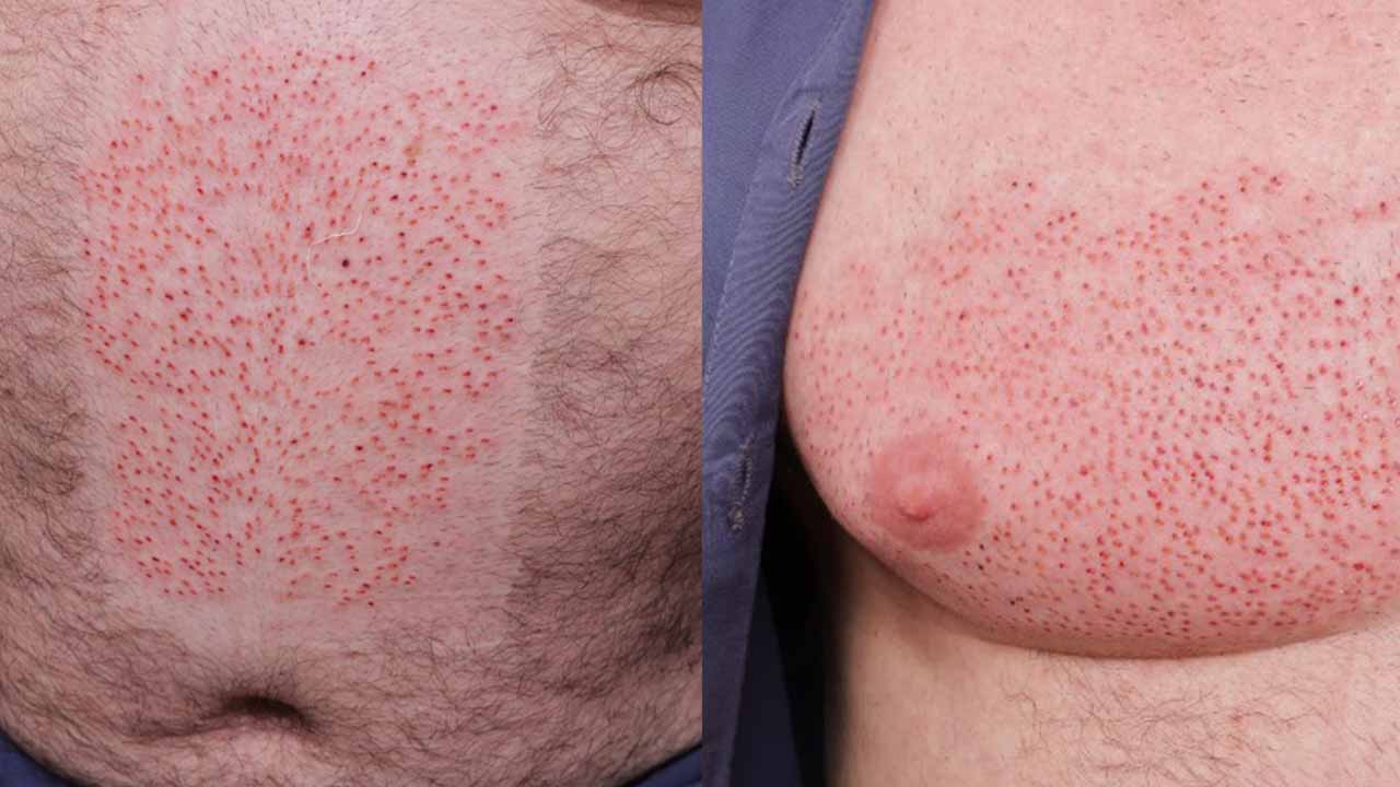 Body Hair Transplant
