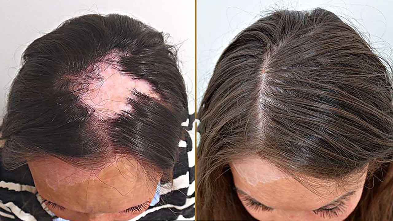 Hair Transplant for Burn or Accident Scars