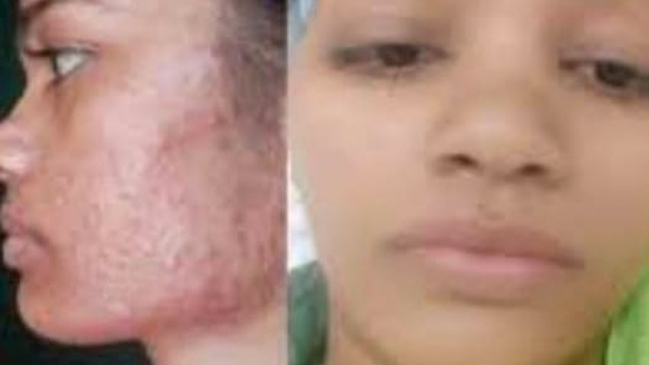 Acne Treatment