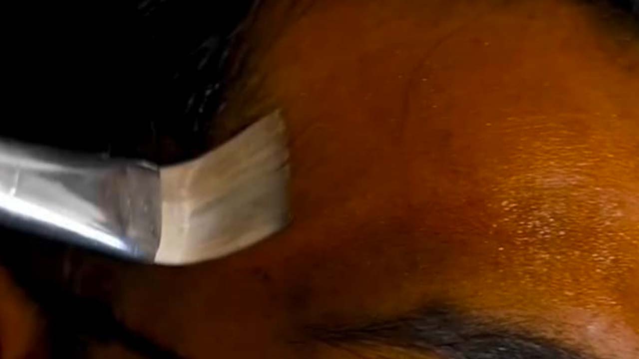 Chemical Peels