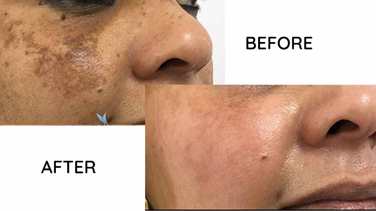 Cosmelan Peel for Persistent Melasma