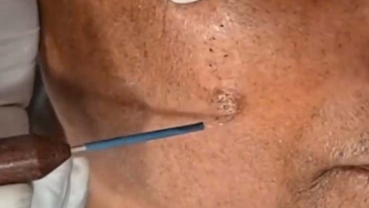 Warts Removal