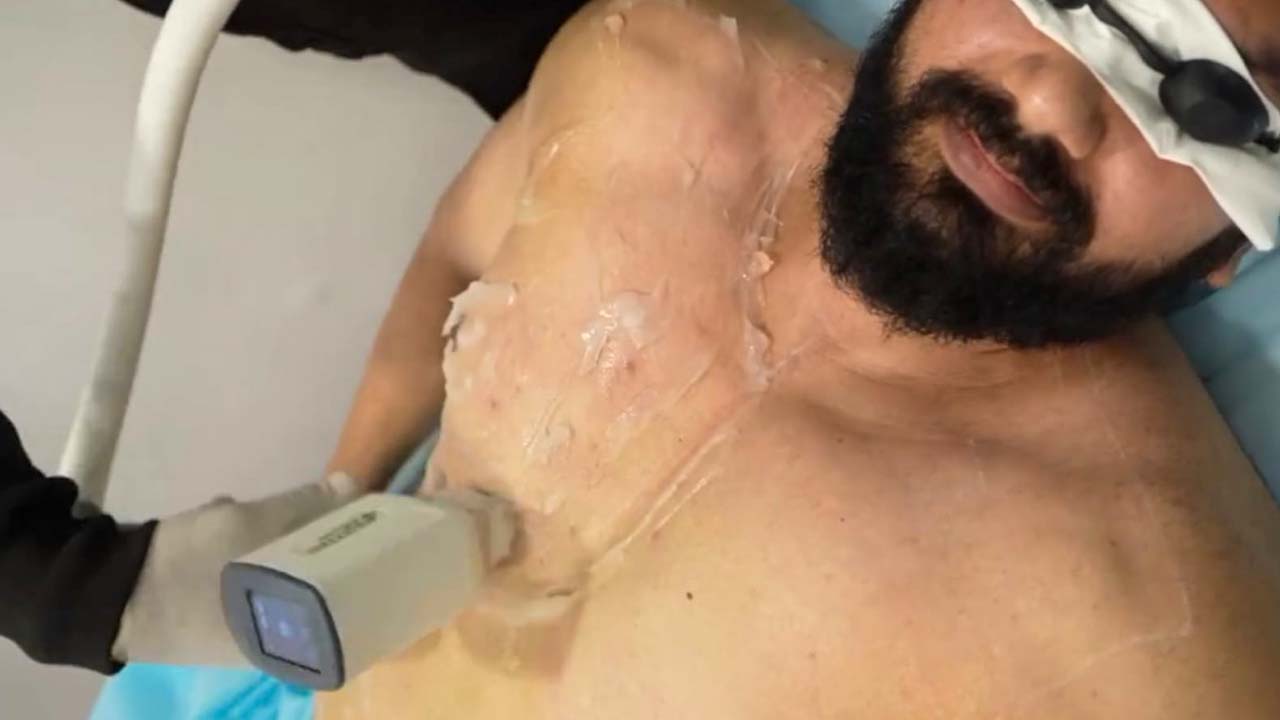 Male Laser Hair Reduction