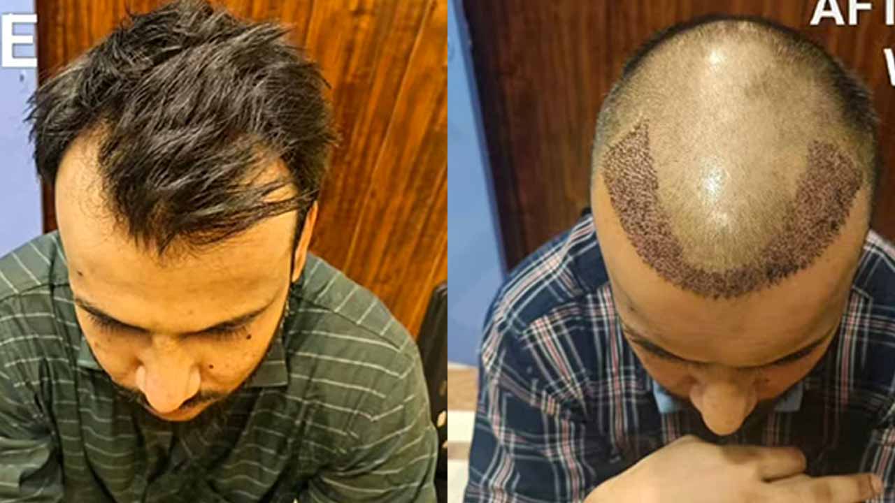Hairline Reconstruction