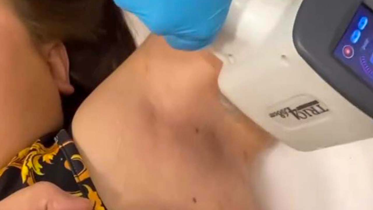 Underarm Laser Reduction